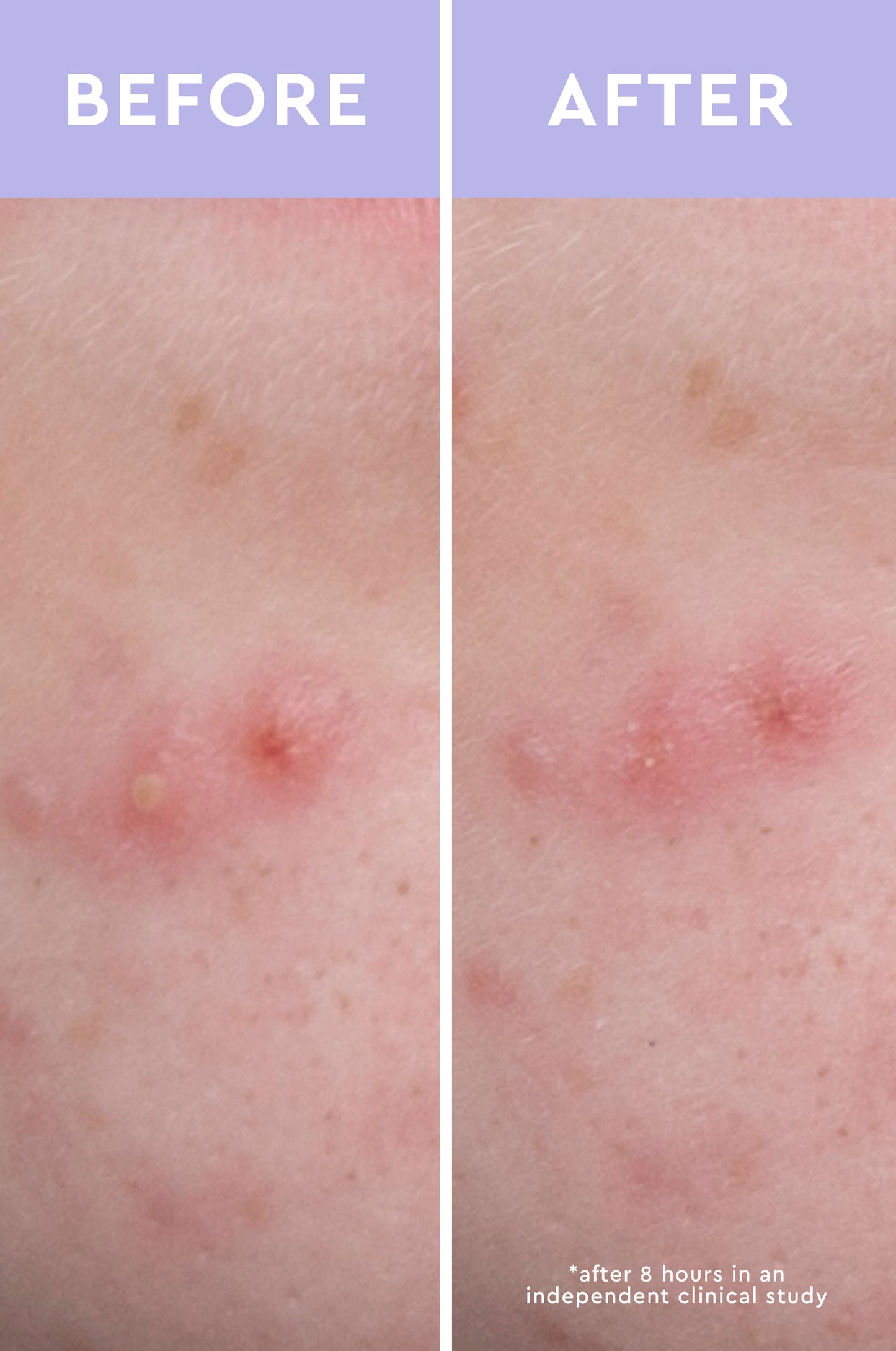 Spot a Spot Acne Patches